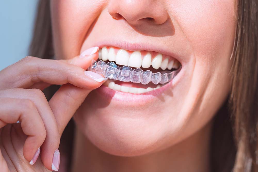 Invisalign London